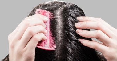 5 طرق للتخلص من قشرة الرأس فى أسرع وقت.. خاصة فى الشتاء