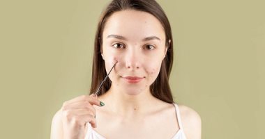 ماذا تفعلين بعد فقع البثور؟.. نصائح وخطوات وقاية يجب اتباعها
