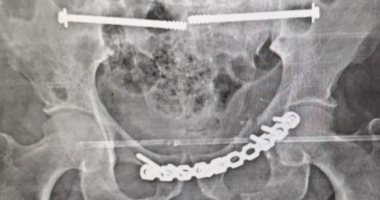 تشغيل وحدة جراحات كسور الحوض بمستشفى النيل فى شبرا.. ونجاح أول عملية جراحية
