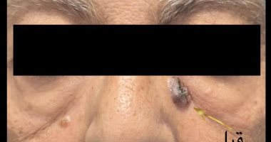 نجاح عملية استئصال ورم سرطانى بالجفن فى مستشفى الرمد العام بالإسكندرية