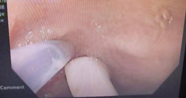 استخراج مضخة عطر من معدة طفل عمره عام و3 أشهر بمستشفى العامرية العام