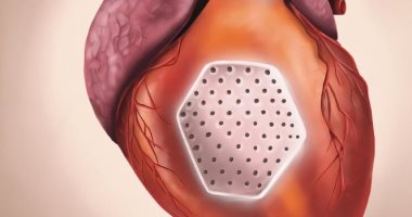بشرى لمرضى قصور القلب.. ترقيع القلب بالخلايا الجذعية آخر صيحة فى الطب ترقيع القلب لعلاج قصور القلب