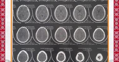 نجاح جراحة معقدة لإنقاذ مصاب بكسر فى الجمجمة بمستشفى المنصورة الدولى