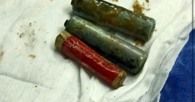 استخراج 3 أحجار ريموت من معدة مريض عانى منها 18 شهرا فى المنوفية