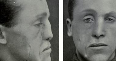 كيف أعادت الجراحة التجميلية الأمل لمصابى الحرب العالمية الأولى.. صور عمليات تجميل المحاربين