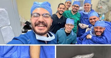 نقابة الأطباء عن إعادة يد مبتورة لشاب بمستشفى سيد جلال: ملحمة ومعجزة طبية أطباء قسم جراحة التجميل بـ كلية طب الأزهر