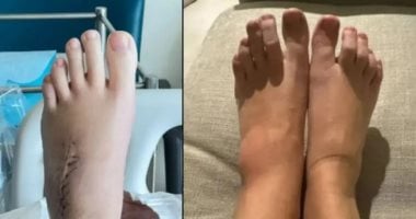 الشبكة نيوز : 
                                            امرأة أصيبت بعدوى فطرية سببت لها فقدان ذاكرة ونوبات صرع.. كيف حدث ذلك؟
                                        