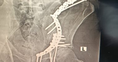 جراحة معقدة.. فريق بمستشفى النيل للتأمين الصحى ينقذ حياة شخص تعرض لحادث سير