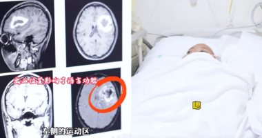 شابة تفقد قدرتها على التحدث بالإنجليزية بعد إتقانها تثير حيرة الأطباء شابة تنسى الانجليزية وتستعيدها بجراحة