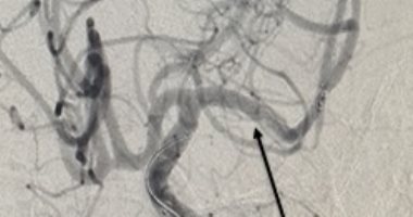 تدخل طبي دقيق ينقذ مريضا في حالة حرجة بمستشفى شبين الكوم التعليمي