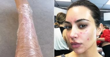 مرض جلدي مناعى تعانى منه كيم كاردشيان يجعلها تغلف جسمها بالبلاستيك كيم كاردشيان