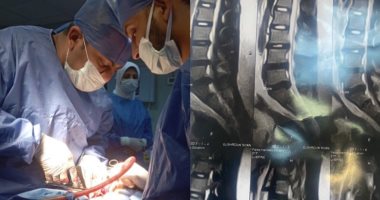 صحة الدقهلية: نجاح جراحة دقيقة بمستشفى تمى الأمديد فى إنقاذ شاب من الشلل جانب من إجراء الجراحة