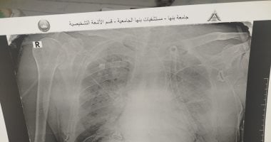 إنقاذ حياة مريض يعانى من غرغرينا بالقولون والأمعاء الدقيقة بمستشفى بنها الجامعى