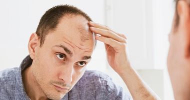 علماء يطورون علاجا جديدا للصلع.. وطرحه بحلول عام 2029 التوصل لعلاج جديد للصلع