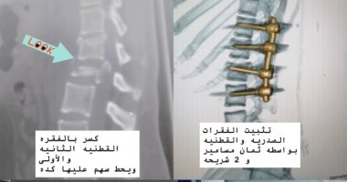 جراحات دقيقة تنقذ 3 مريضات من الشلل بمستشفى تمى الأمديد فى الدقهلية جانب من الجراحات الدقيقة