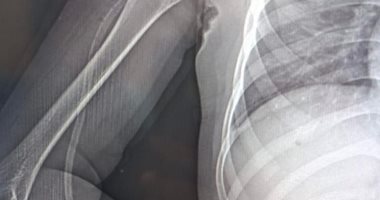 إنقاذ ذراع طفلة من ورم نادر فى عملية دقيقة بمستشفى سوهاج الجامعى.. صور