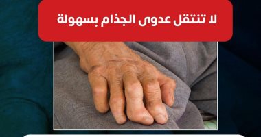 وزارة الصحة: عدوى الجذام لا تنتقل بسهولة واللمس لا يصيب بالعدوى