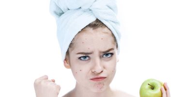 وصفات طبيعية لتهدئة الحبوب الملتهبة في الحر.. بدون مواد كيميائية