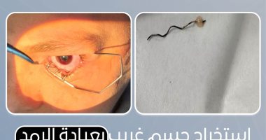الرعاية الصحية بالأقصر تعلن إنقاذ عين طفل فى عملية دقيقة بمستشفى طيبة التخصصي
