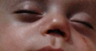 يحيى ملاك برىء ابن الـ7 أشهر يحتاج عمليات ليرى النور.. وأسرته: ظروفنا بسيطة