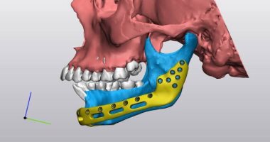 لأول مرة.. تركيب شريحة تعويضية بالفك السفلى "ديجيتال" بمستشفى منوف العام