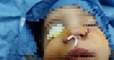 الطفلة بعد الجراحة