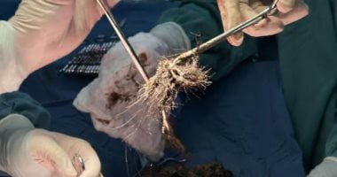 أطباء صينيون يستخرجون كرة شعر وزنها 2 كيلو من معدة فتاة أكوام من الشعر في معدة فتاة