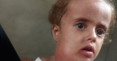 ورم في رقبتها وصعوبة بالنطق.. عجز المنظومة الصحية بغزة يهدد حياة الطفلة جوليا الطفلة جوليا أبو لحية