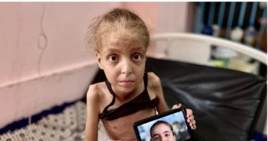 خست 16 كيلو.. طفلة فلسطينية تحول جسدها لهيكل عظمى ووالدتها تناشد بسرعة علاجها الطفلة هدى أبو النجا