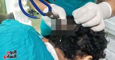 فريق جراحى بالتأمين الصحى ببنها ينقذ حياة مريض باستخراج مقص حديدى من الجمجمة