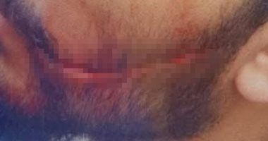 مرافق مريض يعتدى على طبيب بمستشفى سيد جلال ويسبب له عاهة مستديمة