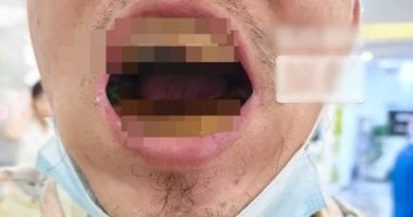 لتوفير المال.. تشوه أسنان رجل صنع أطقمه بالمنزل بمواد اشتراها عبر الإنترنت