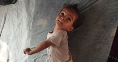 الطفلة الفلسطينية نايا أبو ريدة.. العدوان هدم طفولتها وأصابها بالشلل