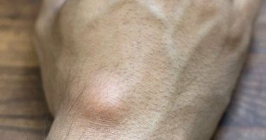 تظهر حول المفاصل.. أطباء يحذرون من محاولة تفريغ أكياس العقد العصبية