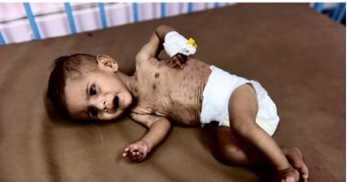 وزنه لا يتعدى 3 كيلو.. سوء التغذية يهدد حياة الرضيع على أبو عاذرة داخل غزة
