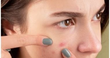 نيوز برو : 
                                            6 نصائح للتعامل مع حب الشباب خلال فترة المراهقة.. تجنب لمس الحبوب أبرزها
                                        