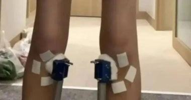 مراهق ينفق ألفى دولار على جلسات زيادة الطول ثم يخسر 1.4 سم بعد أسبوعين