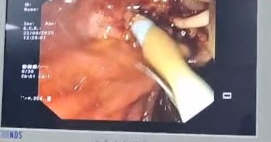 استئصال ورم بدون جراحة بالقنوات المرارية بوحدة المناظير بمستشفى أحمد ماهر