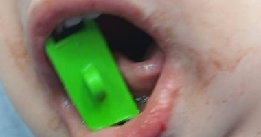 لأول مرة بمستشفى بنها.. عملية جراحية 4 ساعات لطفلة عامين تعانى حالة تيبس بالفكين