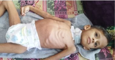 القصف الإسرائيلي يدمر حياة طفل 4 سنوات بإصابات تفقده حواسه ويقتل شقيقه.. صور