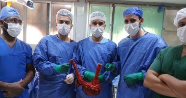 مستشفى الفيوم العام ينجح فى استئصال ورم بالقولون يزن 7 كيلو جرام من بطن مريض