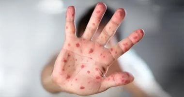 وزارة الصحة توضح بروتوكول علاج مرض HFMD وطرق الوقاية