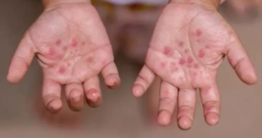 التعليم تكشف تفاصيل ظهور فيروس HFMD بين طلاب إحدى المدارس: رصد 4 حالات ظهرت عليهم أعراض حبوب باليدين واتخاذ الإجراءات الوقائية اللازمة.. ووزارة الصحة: إصابات الفيروس بسيطة ولا تشكل خطرا ولا داعى