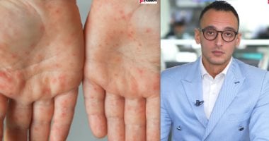 وزارة الصحة: فيروس HFMD لا يشكل خطرا ولا داعى لإغلاق المدارس.. فيديو