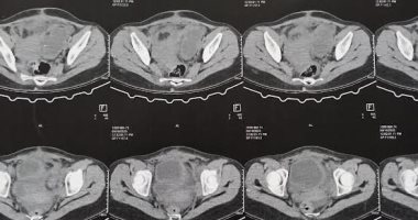استئصال كلية متضخمة بالحوض فى غير موضعها الطبيعى بمستشفى قويسنا المركزى