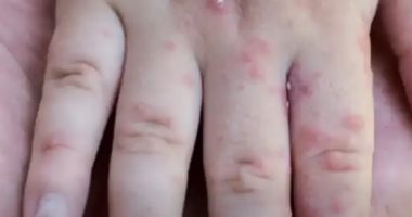 ارتفاع إصابات الجدرى المائى داخل مدرسة فى المنوفية لـ18 طالبا.. تفاصيل