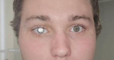 صاحب متجر مجوهرات يرتدى عينا من الألماس بسعر 1.5 مليون جنيه إسترلينى.. صور