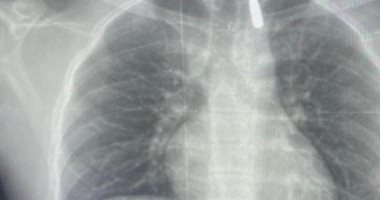 أهل فلسطين فى عيون مصر.. إنجاز طبى جديد بجامعة الإسكندرية لإنقاذ فلسطينى مصاب من قطاع غزة.. تعرض لإصابة بطلق نارى فى الرأس استقر فى تجويف القفص الصدرى