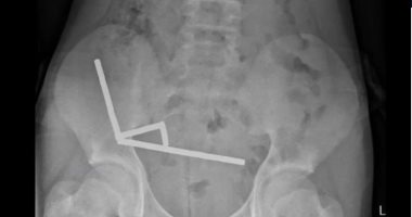 جراحون يزيلون 100 مغناطيس من أمعاء شاب فى نيوزيلندا