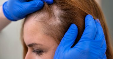  وصفات طبيعية لإنبات البيبي هير.. خطواتها سهلة وآمنة